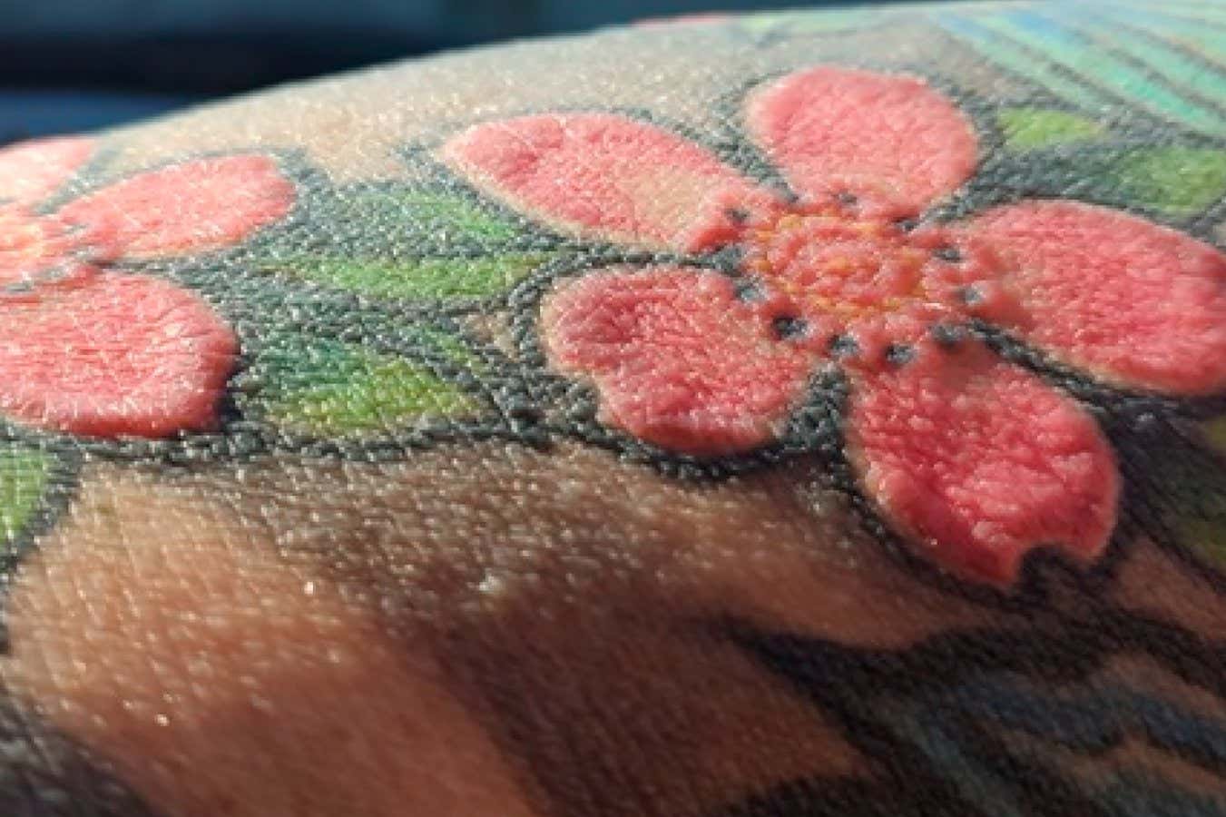 The inflamed parts of the man's tattoo containing red ink